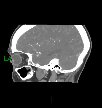 Aneurysmal subarachnoid hemorrhage with intra-axial extension (Radiopaedia 84371-99732 B 18).jpg
