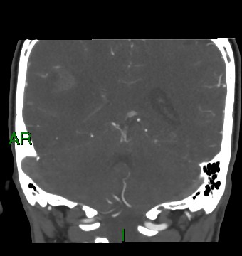 Aneurysmal subarachnoid hemorrhage with intra-axial extension (Radiopaedia 84371-99732 C 36).jpg