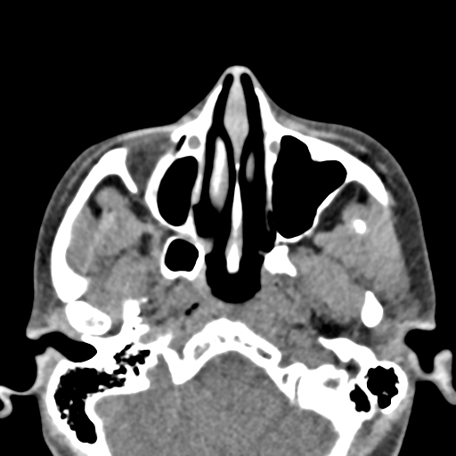 Angular dermoid cyst (Radiopaedia 88967-105790 Axial non-contrast 17).jpg