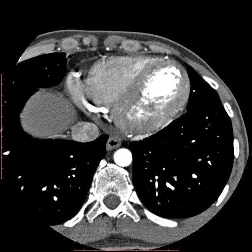 File:Anomalous left coronary artery from the pulmonary artery (ALCAPA) (Radiopaedia 70148-80181 A 309).jpg