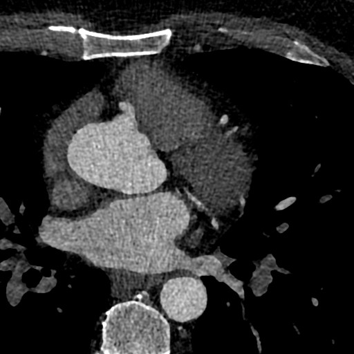 File:Anomalous origin of the left coronary artery with malignant course (Radiopaedia 77842-90126 C 57).jpeg