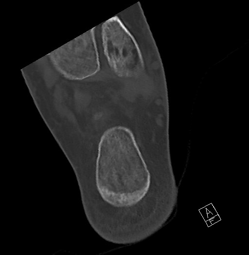 Anterior calcaneal process fracture (Radiopaedia 63353-71943 Axial bone window 116).jpg