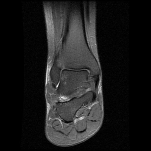 File:Anterior calcaneal process fracture (Radiopaedia 71377-81705 Coronal PD fat sat 8).jpg