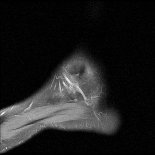 File:Anterior calcaneal process fracture (Radiopaedia 71377-81705 Sagittal PD fat sat 16).jpg