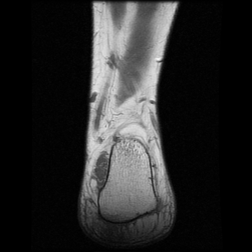 File:Anterior calcaneal process fracture (Radiopaedia 74654-85611 Coronal T1 22).jpg
