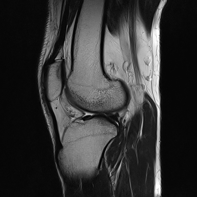File:Anterior cruciate ligament full thickness tear (Radiopaedia 66268-75467 Sagittal T2 15).jpg