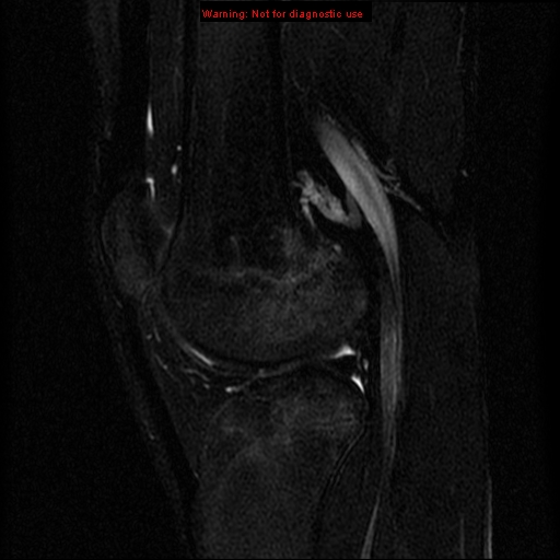 File:Anterior cruciate ligament injury - partial thickness tear (Radiopaedia 12176-12515 Sagittal T2 fat sat 12).jpg