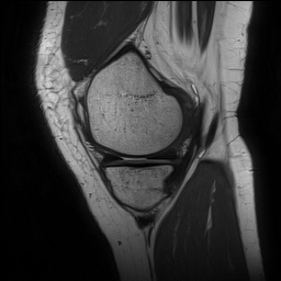 File:Anterior cruciate ligament rupture and posteromedial corner injury (Radiopaedia 67338-76723 Sagittal PD 45).jpg