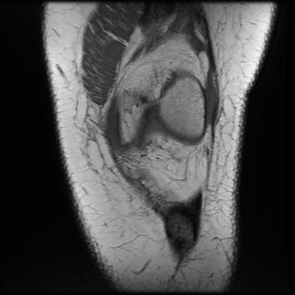 File:Anterior cruciate ligament tear, Wrisberg rip and bucket-handle tear of medial meniscus (Radiopaedia 75872-87266 Coronal T1 8).jpg