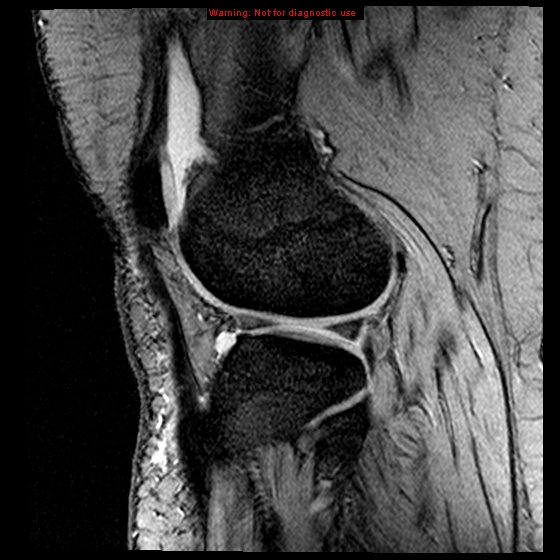 File:Anterior cruciate ligament tear (Radiopaedia 12329-12612 A 5).jpg
