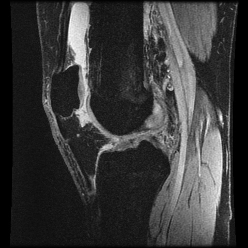 Anterior cruciate ligament tear (Radiopaedia 61500-69462 F 48).jpg