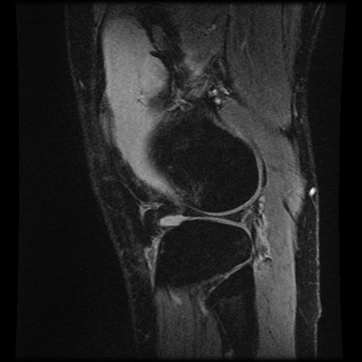 Anterior cruciate ligament tear (Radiopaedia 61500-69462 F 75).jpg