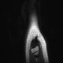 Anterior cruciate ligament tear - pediatric (Radiopaedia 62152-70260 Sagittal PD 167).jpg