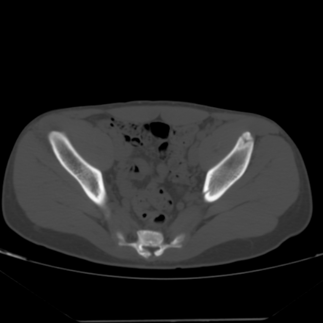 Anterior inferior iliac spine avulsion fracture (Radiopaedia 49469-54627 Axial bone window 25).jpg