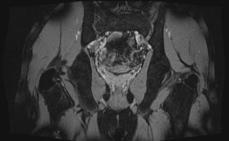 Anterior inferior iliac spine avulsion fracture (Radiopaedia 81312-95000 G 14).jpg