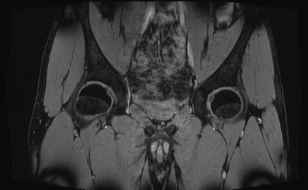 Anterior inferior iliac spine avulsion fracture (Radiopaedia 81312-95000 G 55).jpg