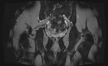 Anterior inferior iliac spine avulsion fracture (Radiopaedia 81312-95000 G 6).jpg