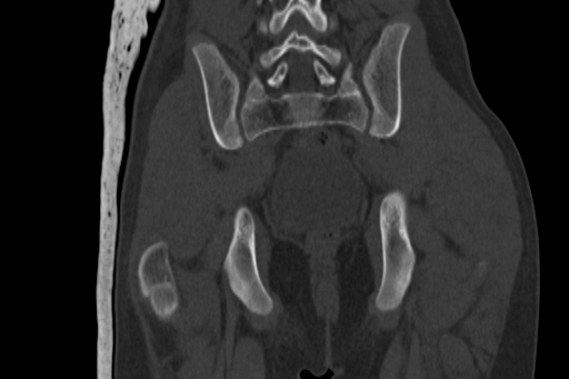 Anterior inferior iliac spine avulsion injury (Radiopaedia 88666-105376 Coronal bone window 51).jpg