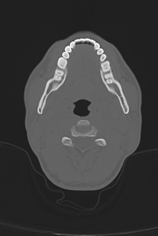 Anterior nasal spine fracture (Radiopaedia 46138-50494 Axial bone window 67).png