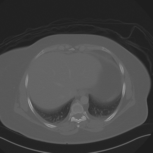 Anterior superior iliac spine avulsion fracture (Radiopaedia 44541-48244 Axial bone window 14).png