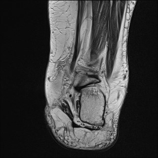 File:Anterior talofibular ligament injury - rupture with soft-tissue impingement (Radiopaedia 38765-40928 Coronal T2 10).jpg