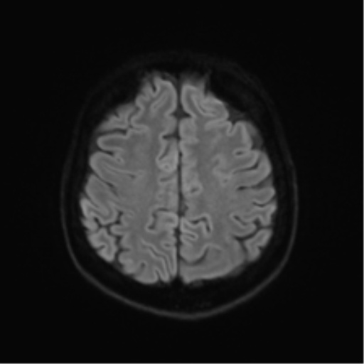 Anterior temporal lobe perivascular space (Radiopaedia 40946-43650 Axial DWI 48).png