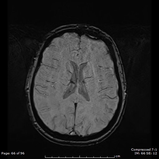 Anterior temporal lobe perivascular space (Radiopaedia 88283-104914 Axial SWI 35).jpg