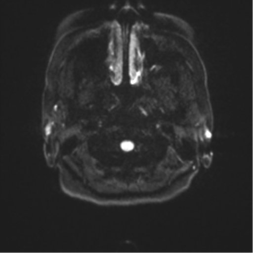 Anterior temporal pole cysts (Radiopaedia 46629-51102 Axial DWI 28).png