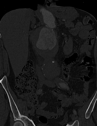 File:Anterior vertebral scalloping (abdominal aortic aneurysm) (Radiopaedia 66744-76067 Coronal bone window 18).jpg