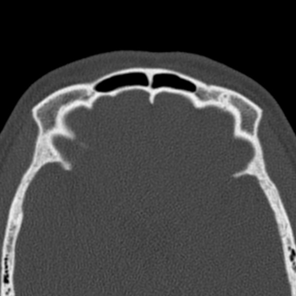Antrochoanal polyp (Radiopaedia 33984-35202 Axial bone window 70).jpg