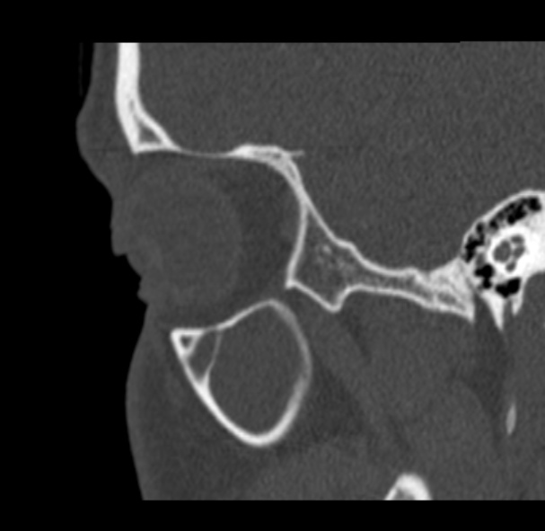 Antrochoanal polyp (Radiopaedia 33984-35202 Sagittal bone window 12).jpg