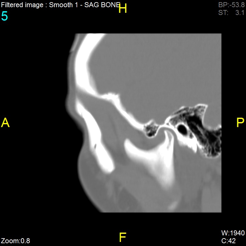 Antrochoanal polyp (Radiopaedia 65101-74094 Sagittal bone window 5).jpg