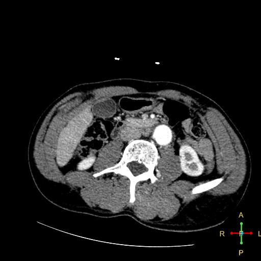 File:Aortic aneurysm and penetrating ulcer (Radiopaedia 23590-23704 A 36).jpg