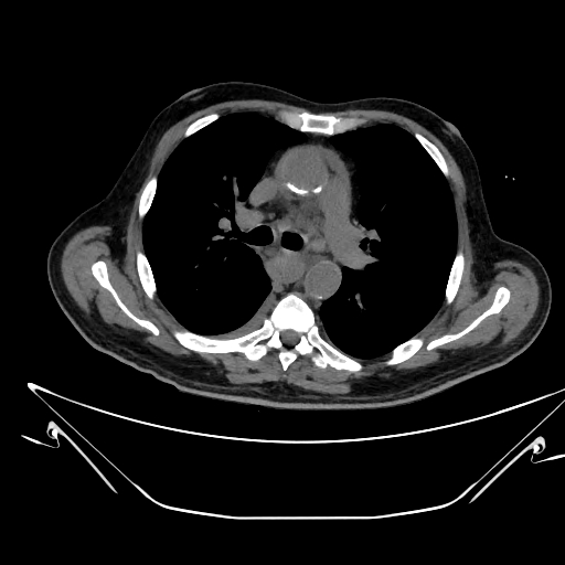 Aortic arch aneurysm (Radiopaedia 84109-99365 Axial non-contrast 117).jpg