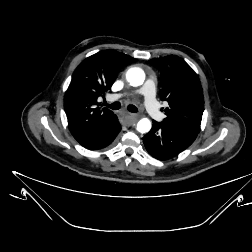 Aortic arch aneurysm (Radiopaedia 84109-99365 C 169).jpg