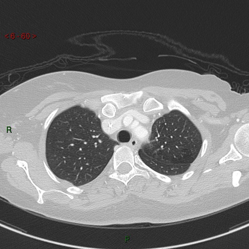 Aortic arch origin of left vertebral artery (Radiopaedia 51520-57286 Axial lung window 60).jpg
