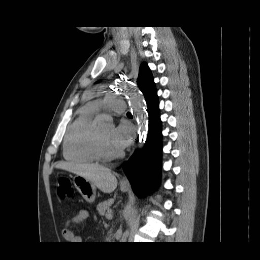 File:Aortic arch stent (Radiopaedia 30030-30595 B 15).jpg