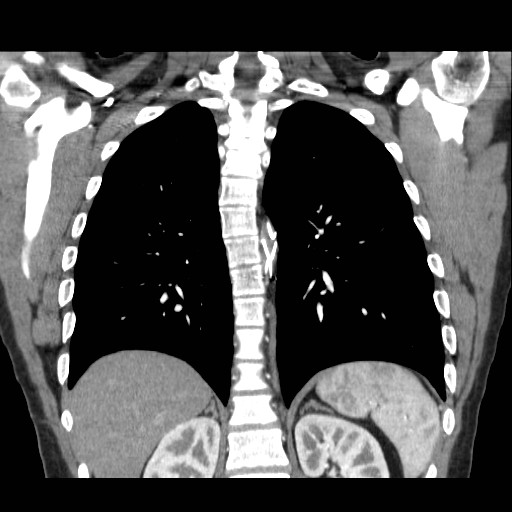 File:Aortic arch stent (Radiopaedia 30030-30595 F 26).jpg
