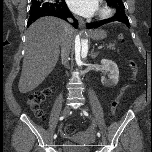 Aortic dissection- Stanford A (Radiopaedia 35729-37268 F 27).jpg