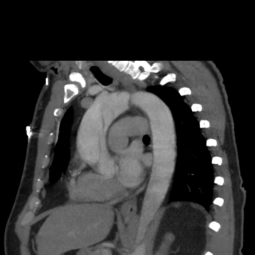 File:Aortic dissection- Stanford A (Radiopaedia 37759-39664 D 16).png