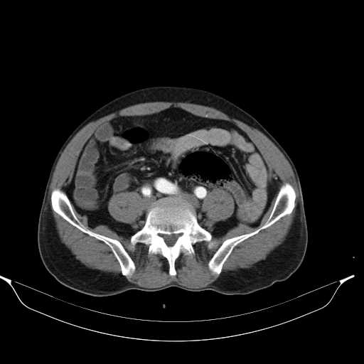 Aortic dissection- Stanford type A (Radiopaedia 22085-22085 A 63).jpg