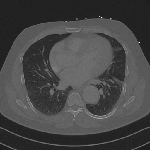 Aortic dissection (Radiopaedia 50763-56234 Axial bone window 61).png