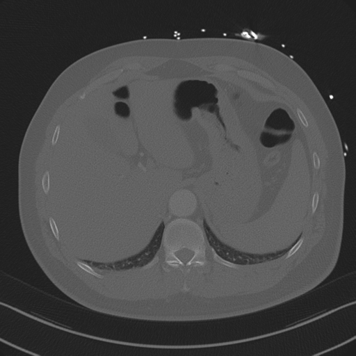 Aortic dissection (Radiopaedia 50763-56234 Axial bone window 92).png
