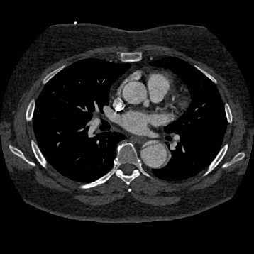 Aortic dissection (Radiopaedia 57969-64959 A 159).jpg