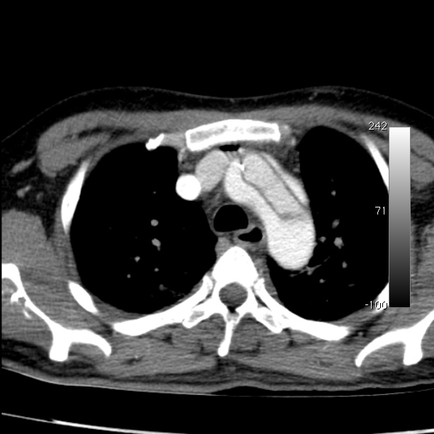 Aortic dissection - Stanford type A (Radiopaedia 29247-29659 A 20).jpg