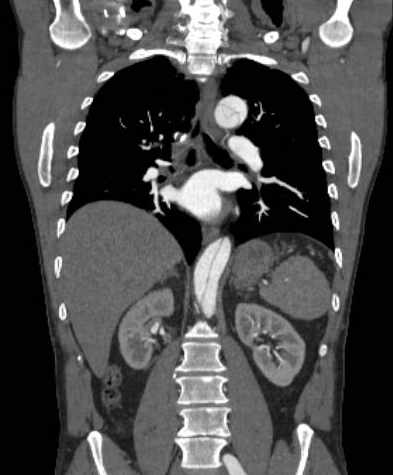 File:Aortic dissection - Stanford type B (Radiopaedia 73648-84437 B 72).jpg