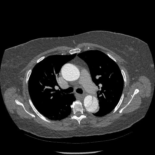 File:Aortic dissection - Stanford type B (Radiopaedia 88281-104910 A 29).jpg