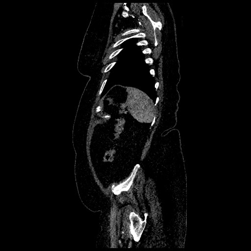 File:Aortic dissection - Stanford type B (Radiopaedia 88281-104910 C 75).jpg