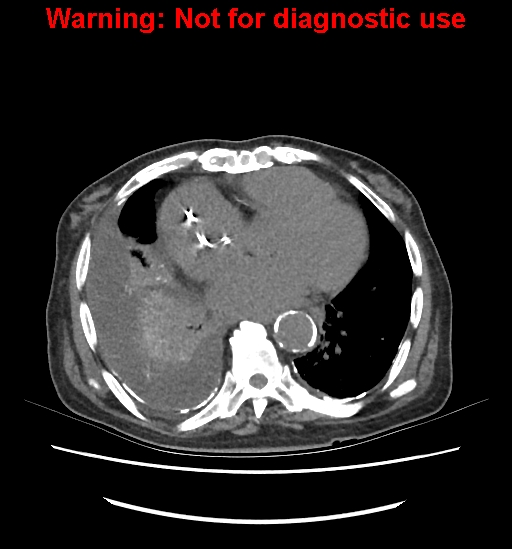 Aortic graft infection (Radiopaedia 44979-48907 Axial non-contrast 9).jpg