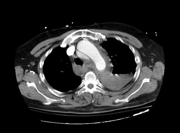 File:Aortic intramural hematoma (Radiopaedia 11198-11562 Axial 1).jpg